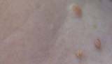 Skin Tags